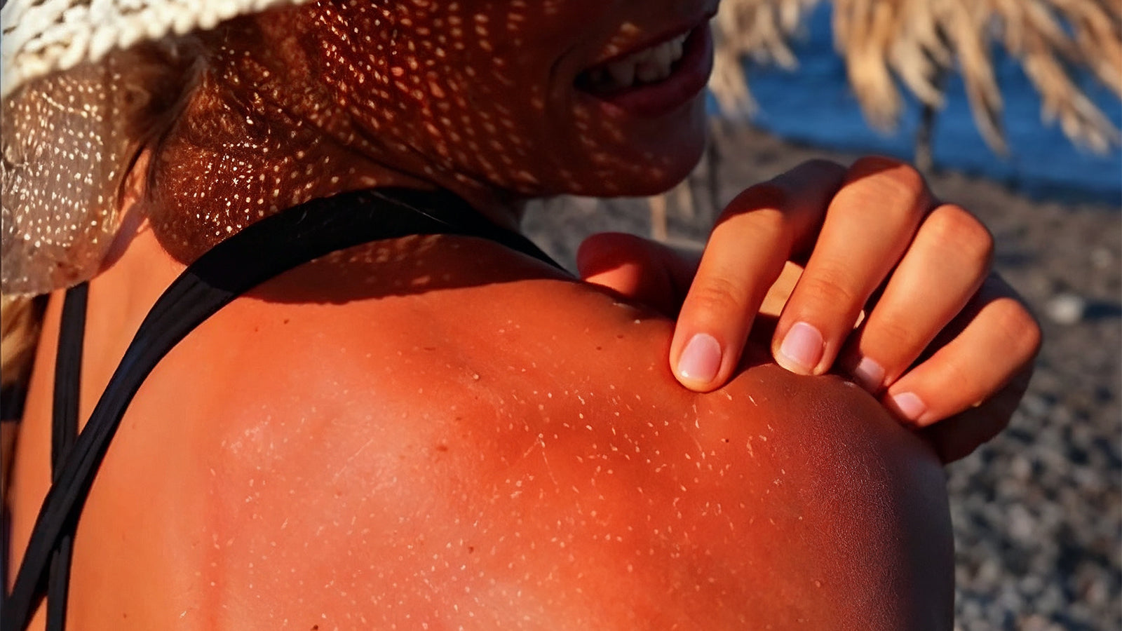 SOS for Sunburn: How to Calm and Repair Your Skin Naturally